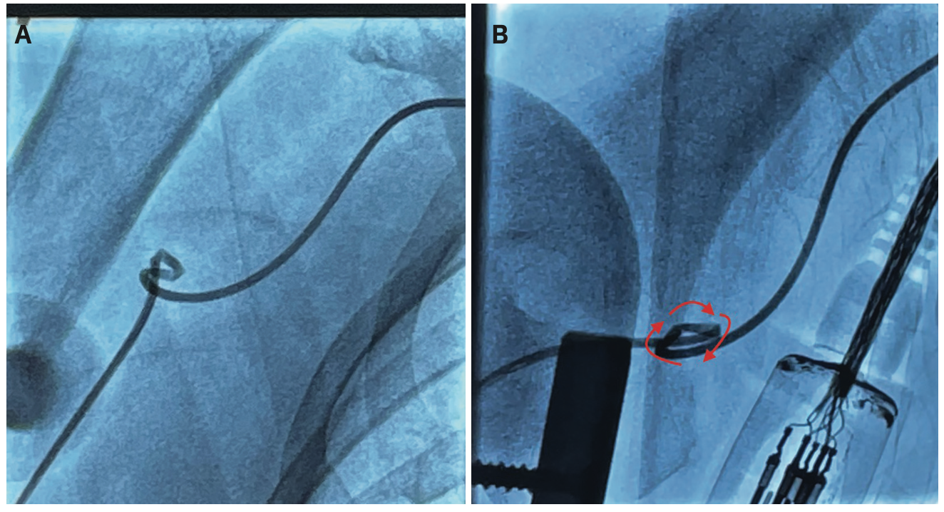 Kinked Catheter Unravelment in the Right Upper Extremity An